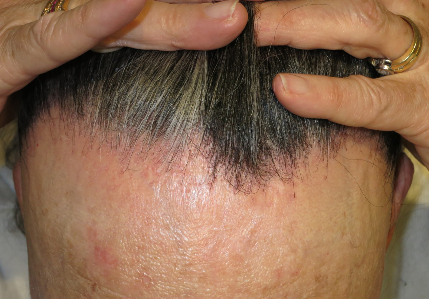 Frenesí Redondo Cruel Alopecia Frontal Fibrosante | doctorjavierdiaz.com